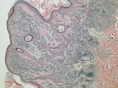 меланоцитарный папилломатозный интрадермальный невус